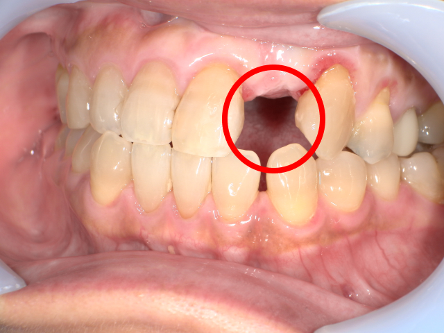 インプラント治療の口腔内写真
