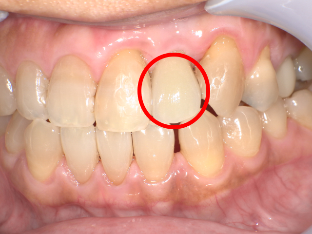 インプラント治療の口腔内写真