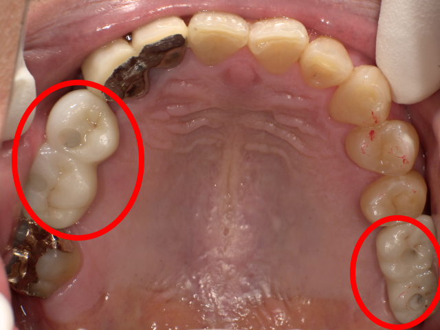 インプラント治療の口腔内写真