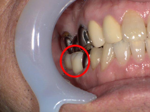 インプラント治療の口腔内写真