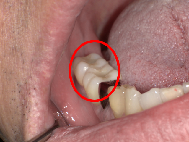 インプラント治療の口腔内写真