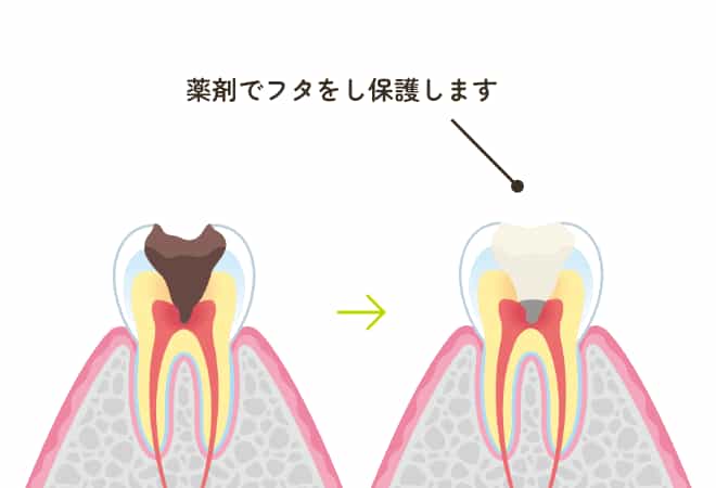 歯髄温存療法の治療説明