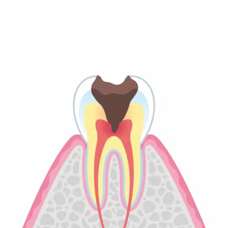 歯髄温存療法のイラスト